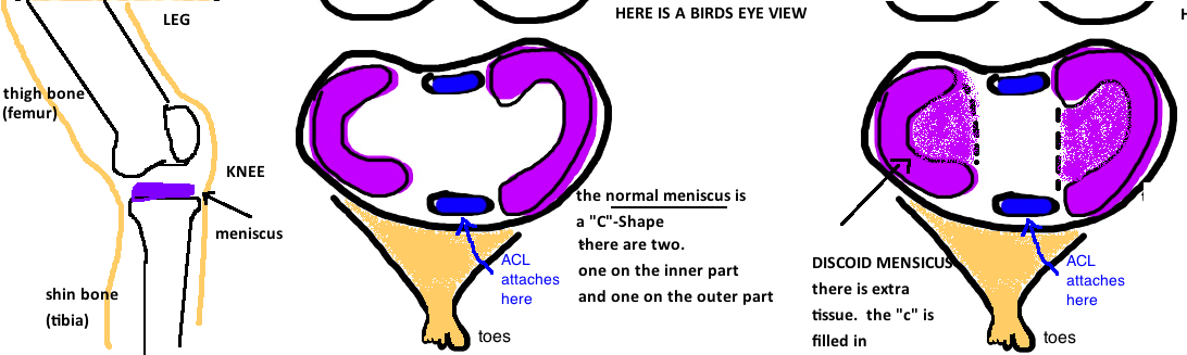 Discoid sale lateral meniscus
